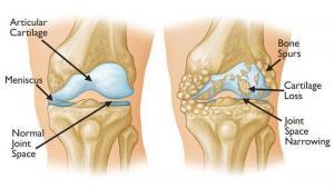 Osteoarthritis-Knee-inflammed | WiSE Specialist Emergency | Robina | Macquarie Park